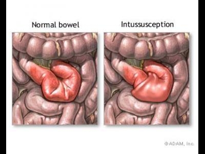 imagini ocluzie intestinala